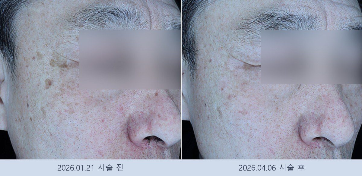 흑자 검버섯